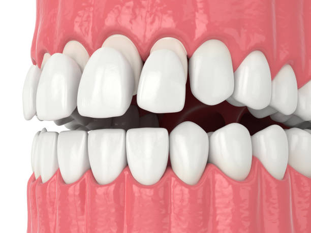 istock 3d render of jaw with teethand upper veneers 1177647451