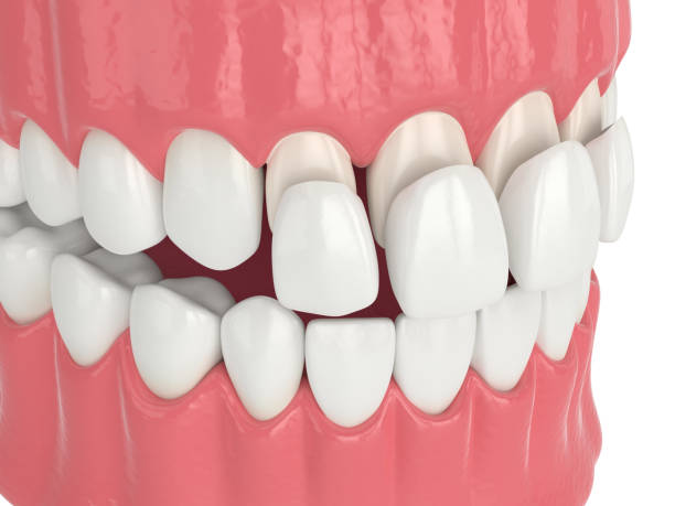 istock 3d render of jaw with upper veneers 1177647454