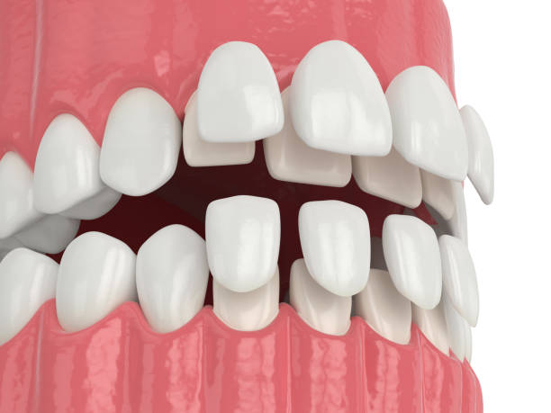 istock 3d render of jaw with upper and lower veneers 1177647455