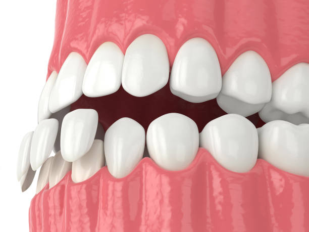 istock 3d render of jaw with lower veneers 1177647460