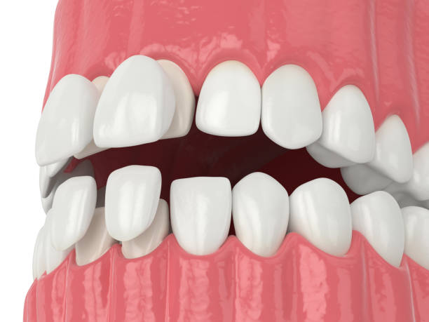 istock 3d render of jaw with upper and lower veneers 1177647464