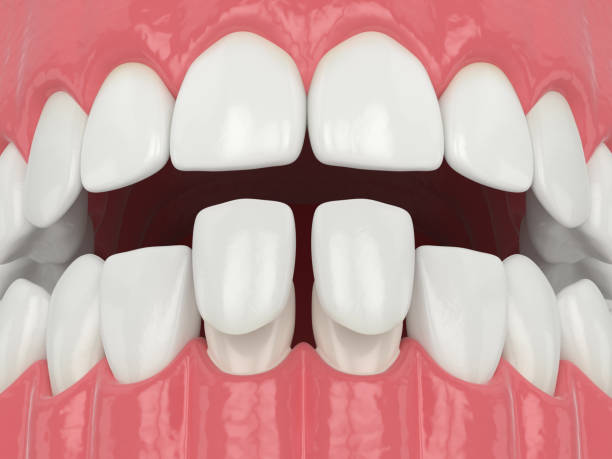 istock 3d render of jaw with lower veneers 1177647468