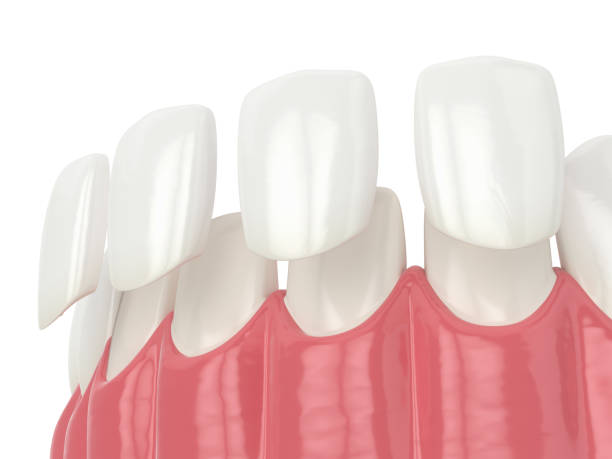 베니어가있는 치아의 3d 렌더링 - 자기 그릇 뉴스 사진 이미지