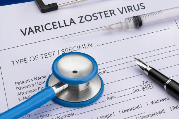 varicella-impfstoff - varicella zoster virus - windpocken - zoster stock-fotos und bilder