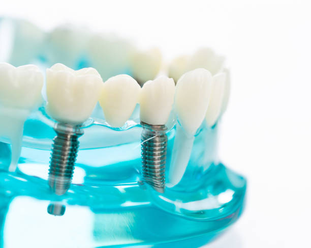 modelo dental sobre fondo blanco - dental implant dental hygiene dentures prosthetic equipment fotografías e imágenes de stock