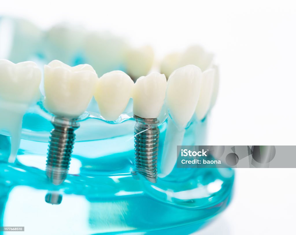 Dental model on white background Dental model on white background. Dental Implant Stock Photo