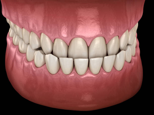 istock Underbite dental occlusion ( Malocclusion of teeth ). Medically accurate tooth 3D illustration 1177997732