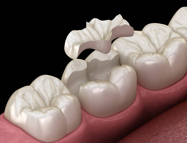 istock Inlay ceramic crown fixation over tooth. Medically accurate 3D illustration of human teeth treatment 1177997800