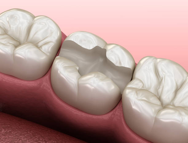 istock Tooth preparation for inlay placement. Medically accurate 3D illustration of human teeth treatment 1177997806