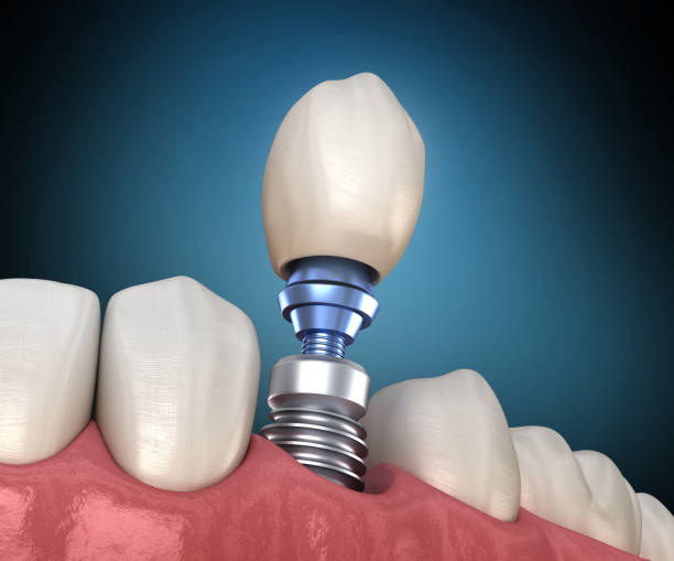 premolar tooth recovery with implant. medically accurate 3d illustration of human teeth and dentures concept - implantat imagens e fotografias de stock