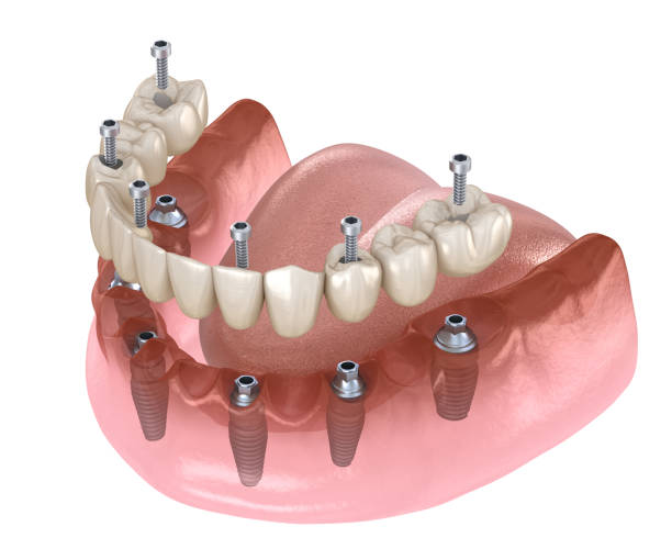 prótesis mandibular sistema todo en 4 apoyado por implantes, fijación de tornillo. ilustración 3d médicamente precisa del concepto dental - teeth implant fotografías e imágenes de stock