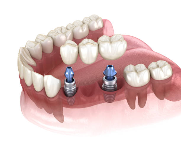 puente dental apoyado por implantes. ilustración 3d médicamente precisa del concepto de dientes y detduras humanas - premolar fotografías e imágenes de stock