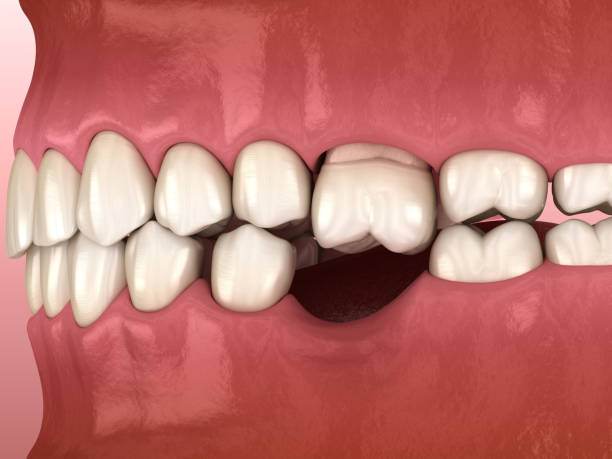 istock Teeth shift deformatiuon after losing molar tooth. 3D illustration of Popov Godon phenomenon 1177997989