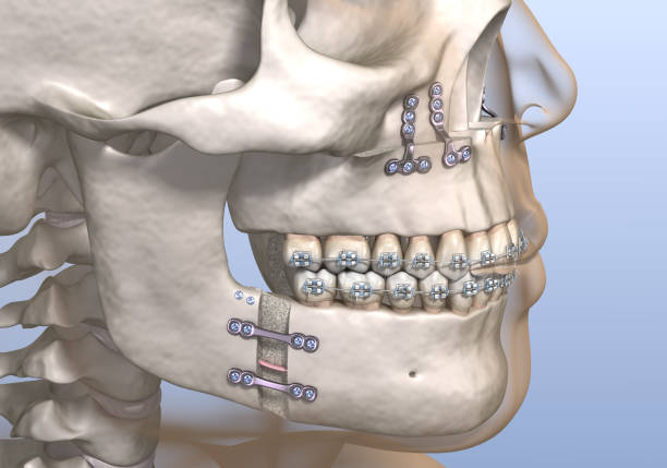 maxillomandibular advancement surgery. medically accurate dental 3d illustration. - implantat imagens e fotografias de stock