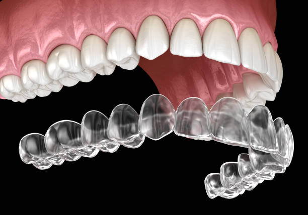 llaves invisalign o retenedor invisible. ilustración dental 3d médicamente precisa - straightener fotografías e imágenes de stock