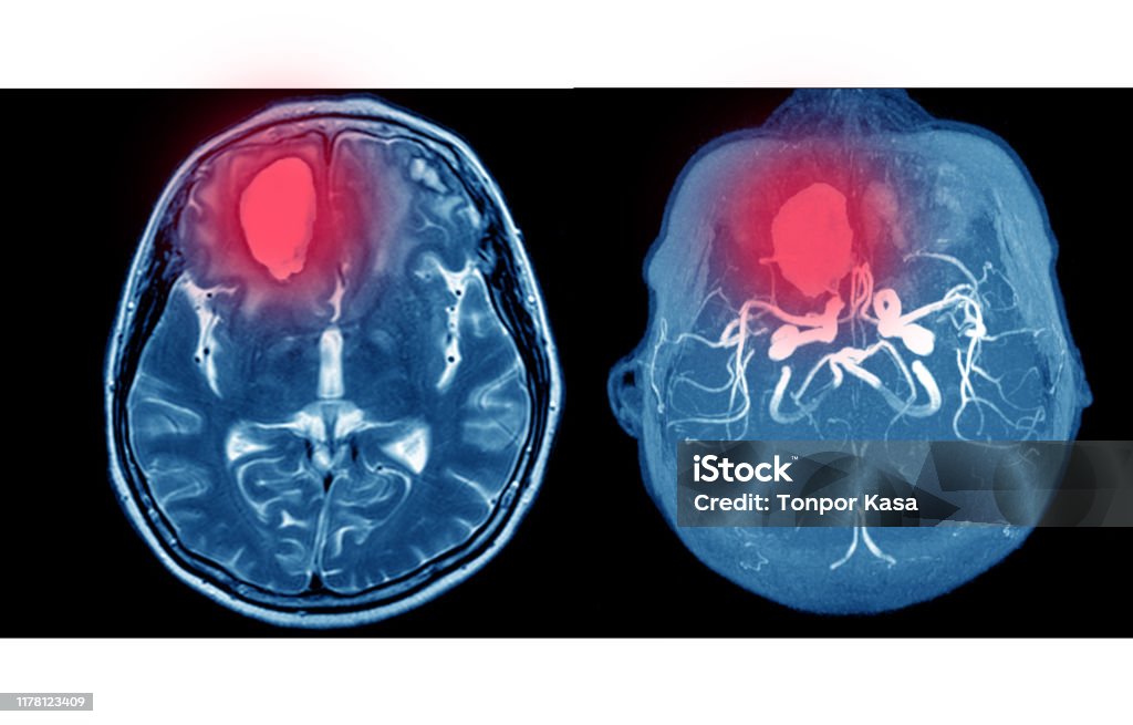 MRA AND MRV OF BRAIN Multiple acute intracranial hemorrhage at bilateral frontal lobes. MRA AND MRV OF BRAIN IMPRESSION:Multiple acute intracranial hemorrhage at bilateral frontal lobes.on red collor mark.Medical and healthcare concept. Aneurysm Stock Photo