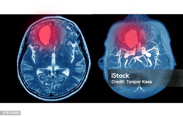 Mra And Mrv Of Brain Multiple Acute Intracranial Hemorrhage At Bilateral Frontal Lobes Stock Photo - Download Image Now