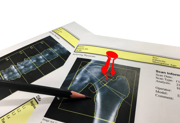 istock Hip and Spine Bone mineral density (BMD) DEXA densitometry hip scan. Osteopenia present, frequent precursor to osteoporosis 1178124961