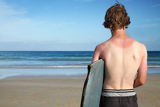 Il surfista bruciata dal sole. - foto stock