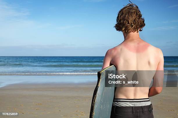 The Sunburnt Surfer Stock Photo - Download Image Now - Sunburned, Teenager, Adolescence