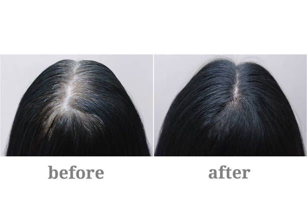Before After Hair Stock Photos, Pictures & Royalty-Free Images - iStock Before After Hair Stock Photos, Pictures & Royalty-Free Images - iStock
