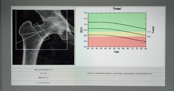 istock Bone Examination hip  represents osteoporosis 1178685101