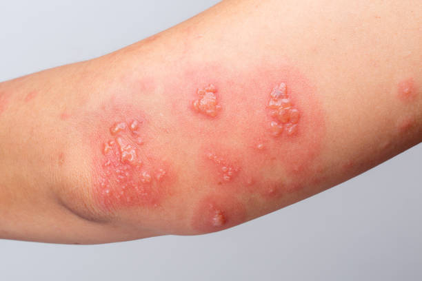 istock Shingles, Zoster or Herpes Zoster symptoms on arm 1178714298