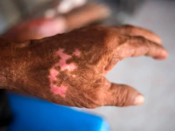 White spotted skin disease on arms asian man.The skin fungus is very itchy.