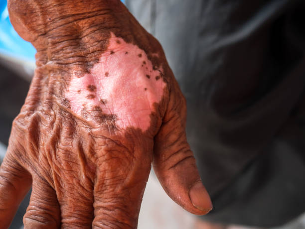 White spotted skin disease on arms asian man.The skin fungus is very itchy. White spotted skin disease on arms asian man.The skin fungus is very itchy. mycobacterium leprae stock pictures, royalty-free photos & images