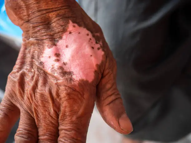 White spotted skin disease on arms asian man.The skin fungus is very itchy.