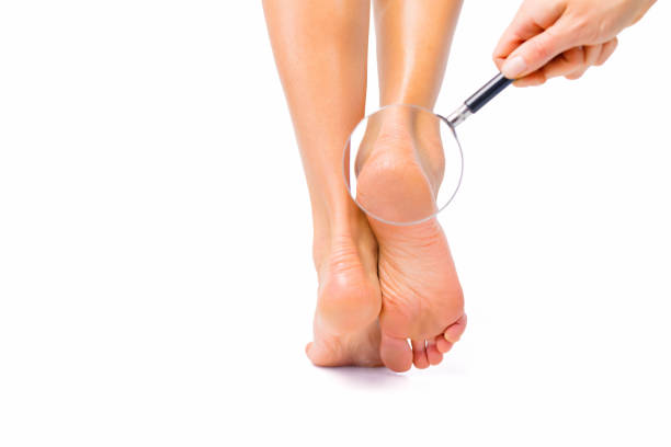 금이 발 뒤꿈치 문제를 가진 여자 - human leg smooth human skin human foot 뉴스 사진 이미지