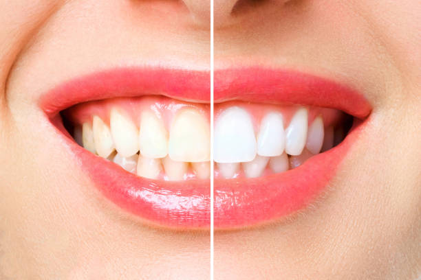 istock woman teeth before and after whitening. Over white background 1178774030