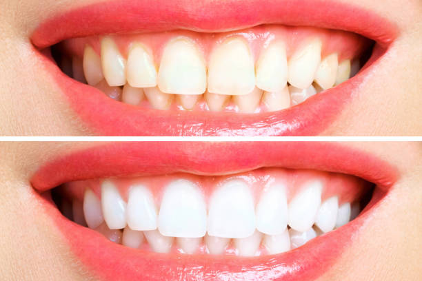 istock woman teeth before and after whitening. Over white background 1178774037