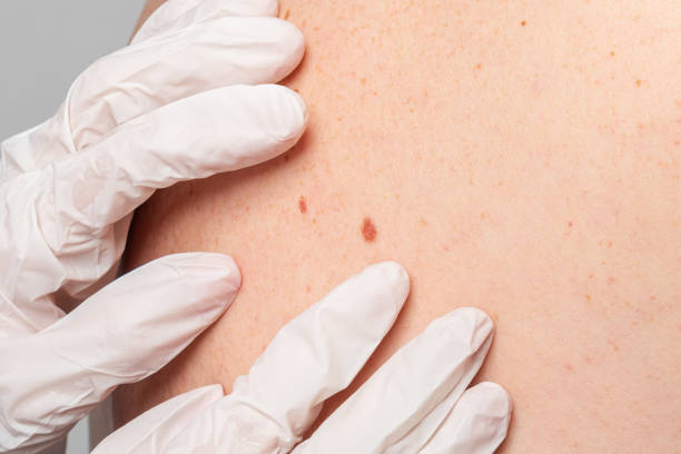istock A doctor with gloves examines a liver spot on a person's back 1178799600