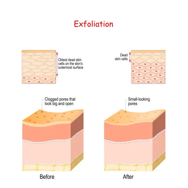 Vector illustration of Cross-section of skin layers before and after Exfoliation