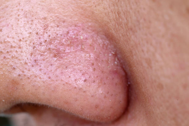 istock close-up blackheads on the nose 1178974983
