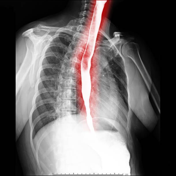 esophagramm - barium stock-fotos und bilder