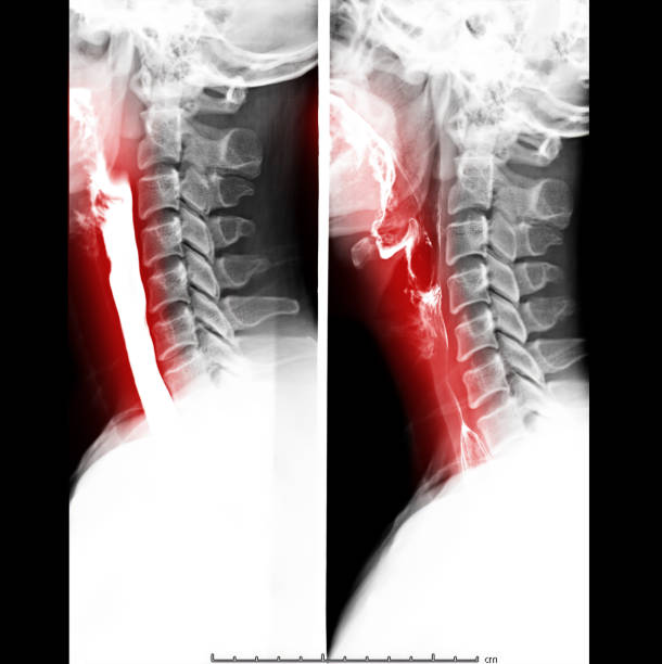 esophagramm - barium stock-fotos und bilder