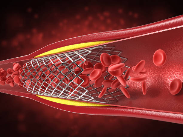 procedimiento de angioplastia con balón - angioplasty fotografías e imágenes de stock