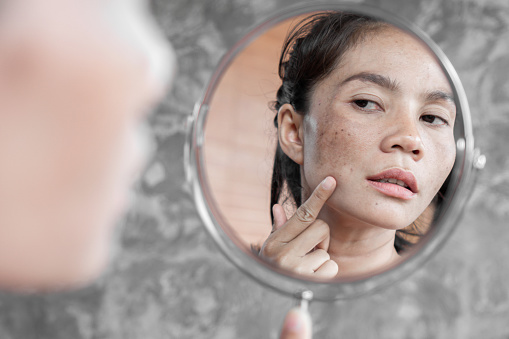 Mujer asiática que tiene problemas de piel comprobar su cara con mancha oscura, pecas de la luz uv en el espejo photo