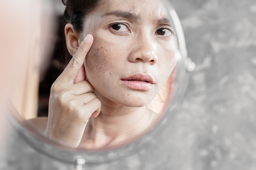 Mujer asiática que tiene problemas de piel comprobar su cara con mancha oscura, pecas de la luz uv en el espejo photo