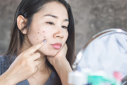 mujer asiática infeliz comprobar su problema de la piel de la cara con mancha oscura de acné cicatriz photo