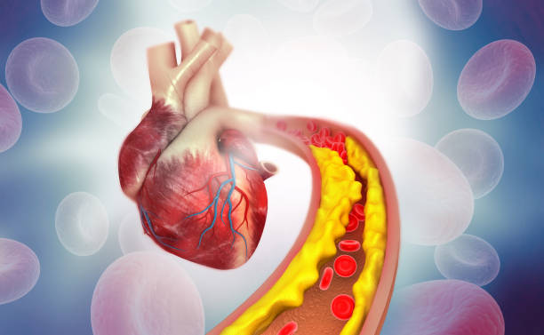 인간의 심장 해부학과 동맥에 콜레스테롤 플라크 - cholesterol 뉴스 사진 이미지