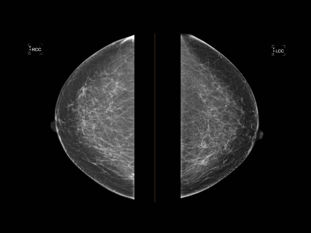 マンモグラムまたはマンモグラフィーは正常な健康な人間の乳房を示す。診断に使用されるマンモグラム、乳癌の早期発見のためのスクリーニング。医療画像と乳がんスクリーニングの概念 - physical therapy ストックフォトと画像