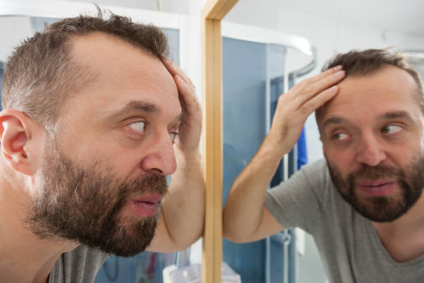 istock Worried man looking at his decreasing hairline 1179233027