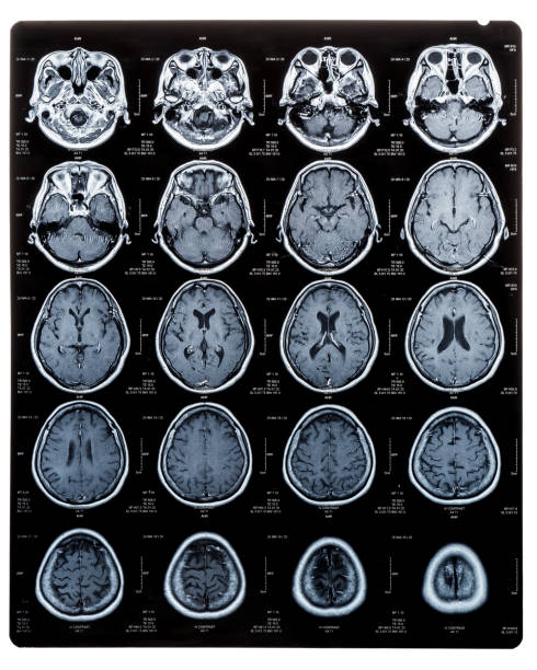 brain scan bild på magnetisk resonanstomografi (mri) film av äldre patient isolerade (urklippsbana) för neurologisk medicinsk diagnos på hjärnsjukdom - brain scan' bildbanksfoton och bilder