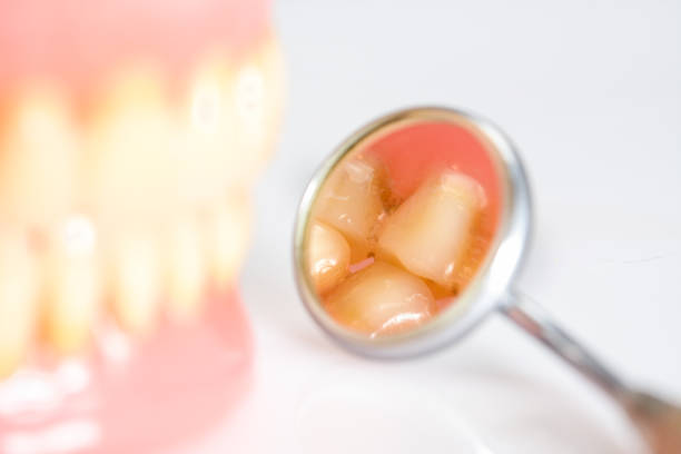 Prosthetic dentist examines an old denture in a dental mirror, close up.