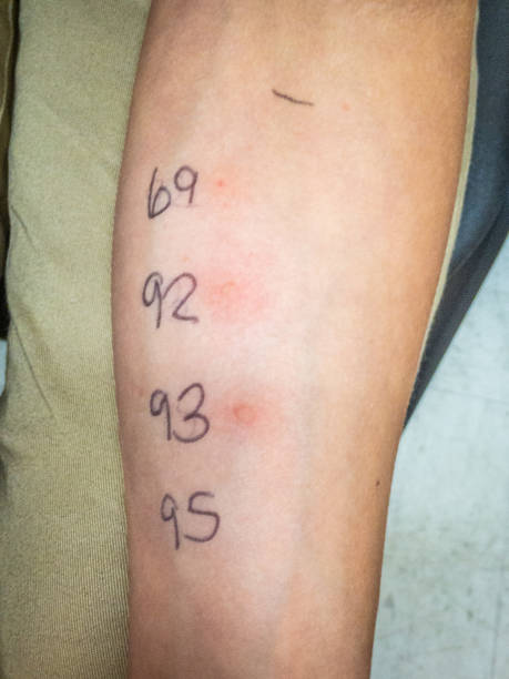 istock Results of allergy skin test 1179459761