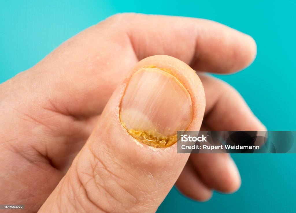 Fingernail psoriasis Left hand thumb with fingernail psoriasis. Psoriasis is an autoimmune disease. Fingernail Stock Photo
