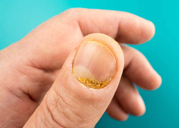 Fingernail psoriasis Left hand thumb with fingernail psoriasis. Psoriasis is an autoimmune disease. bed of nails stock pictures, royalty-free photos & images